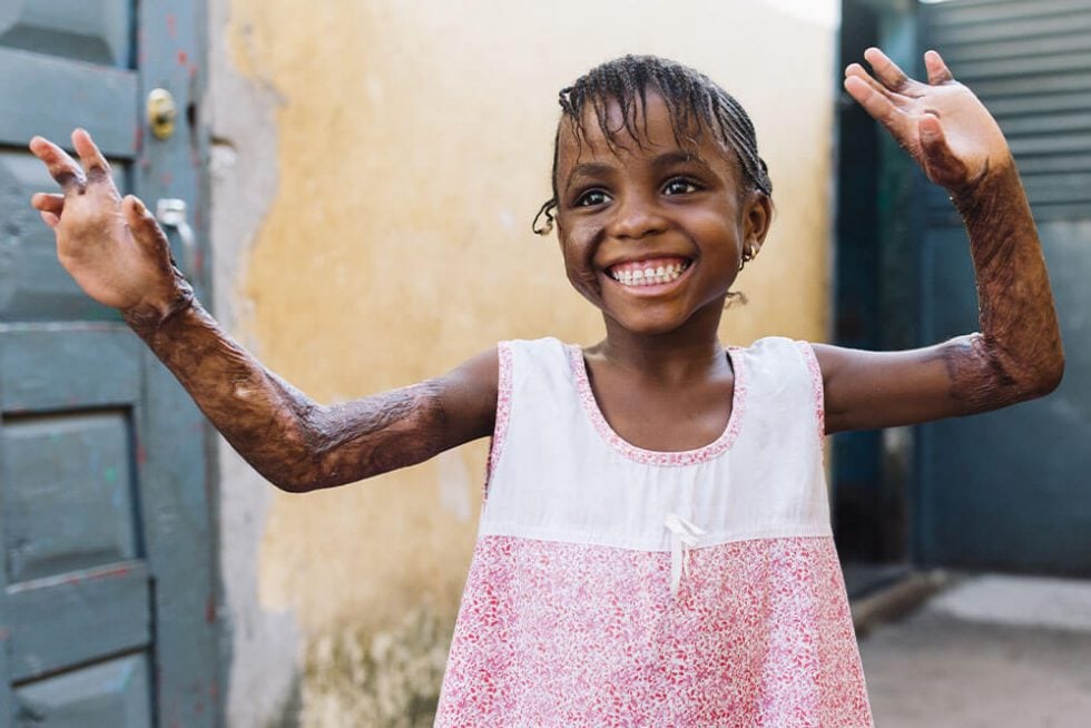 mercyshipssurgicalproceduresplasticreconstructivegamaiafter Mercy Ships